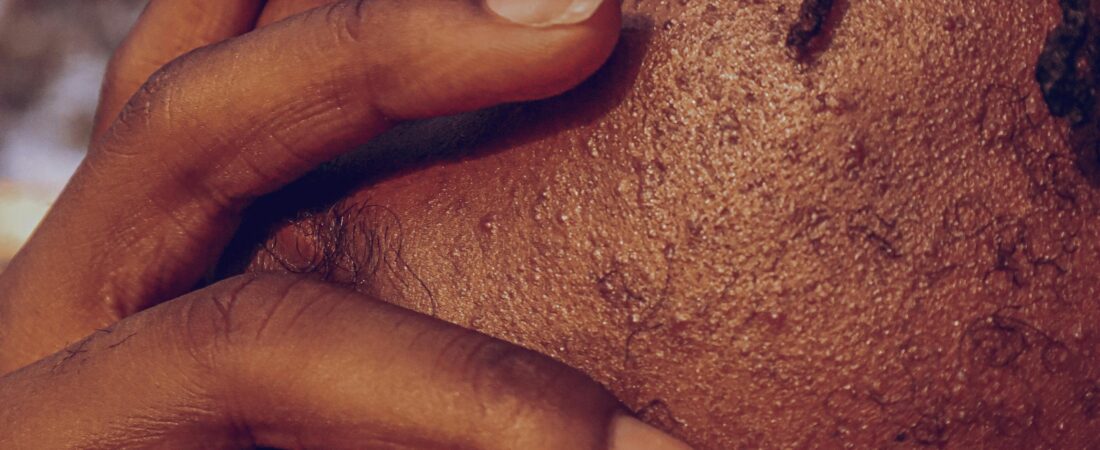 Pelos Encravados na Barba: Como Evitar e Tratar de Vez