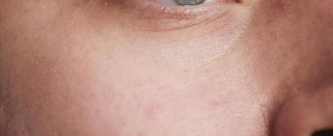 Manchas no Rosto Masculino: Causas e Como Tratar