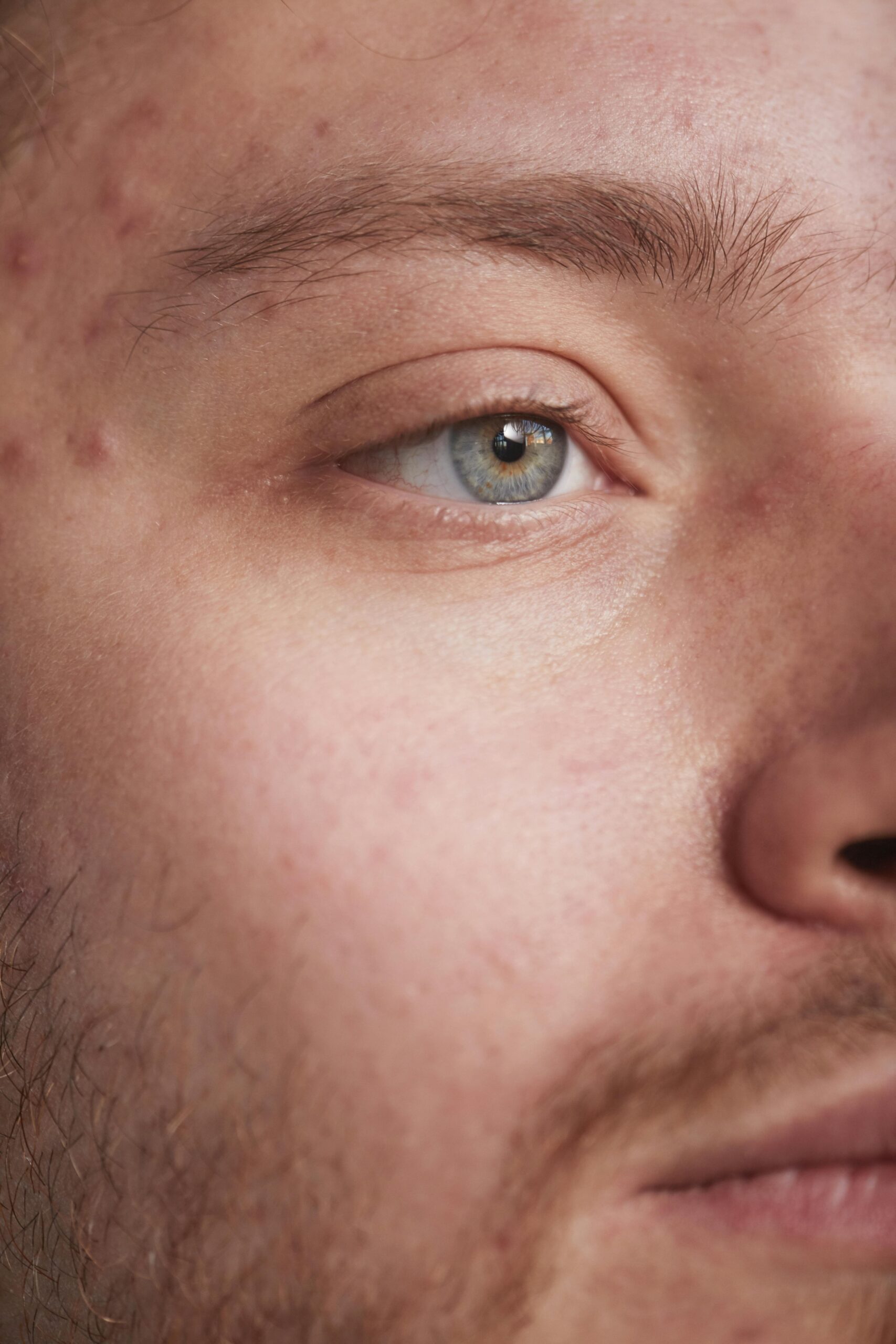 Manchas no Rosto Masculino: Causas e Como Tratar